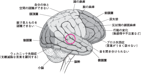 脳の機能障害 １ はじめに 脳が損傷を受けると さまざまな機能障害が起こります 障害の範囲は 昏睡のような完全な意識消失からせん妄のような見当識障害と注意力の 欠如 さらには意識的な行動を行うための種々の機能的欠陥まで多岐にわたります